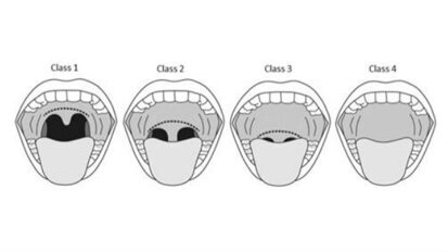 Trattamento dei disturbi del sonno con Laser Er:YAG Fotona