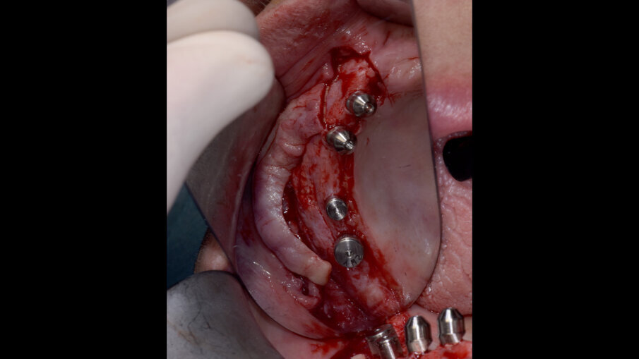 Obr. 10: Separovaný lalok při fázi odkrytí s nasazenými vhojovacími abutmenty. 