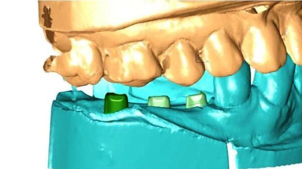 Analiza odbudowy protetycznej na implantach BellaTek Encode i Atlantis