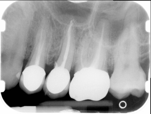 Fig. 2 - Radiografia endorale di controllo, eseguita con centratore.