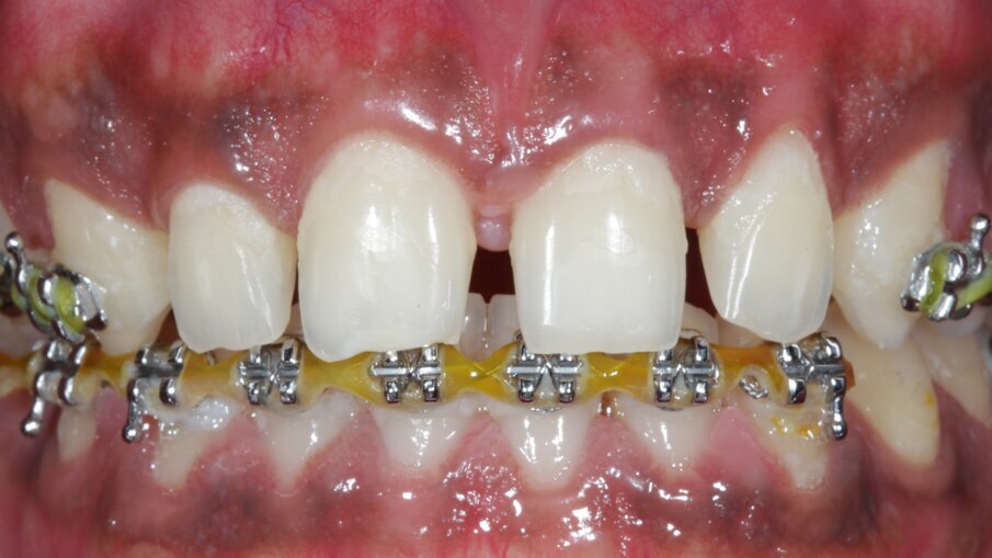 Fig 6: Post-orthodontic treatment completion