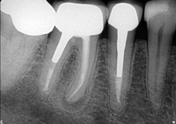 Slučaj 2 – Slika br. 4: Inicijalni periapikalni Rtg snimak