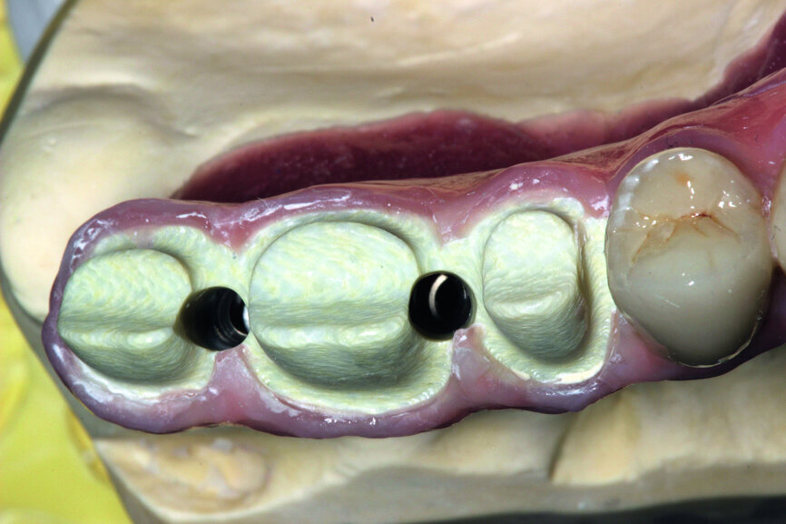 Fig. 21: Openings for screws are located before placing the crowns.