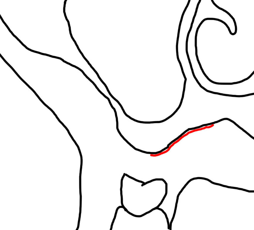 Ryc. 1b_Nacięcie i odwarstwienie płata śluzówkowo-okostnowego. Cięcie rozpoczęto na szczycie wyrostka, w okolicy kła/zębów przedtrzonowych wykonano cięcie uwalniające.