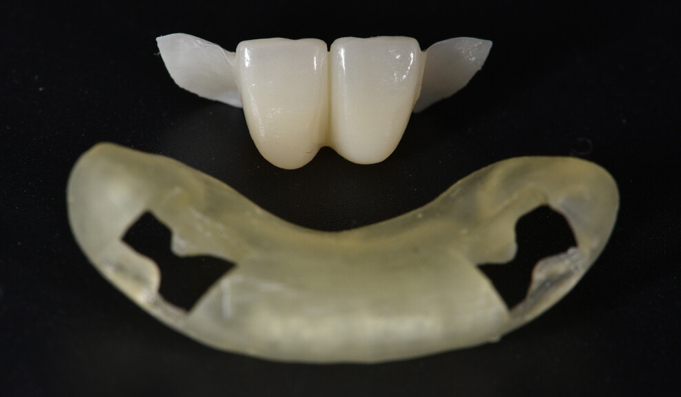 Fig. 8: Milled bridge and 3D-printed key after polishing and staining.