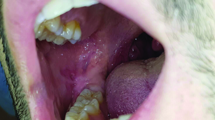 Fig. 2 - L’immagine mostra come la lesione sia totalmente regredita dopo 5 giorni di trattamento.