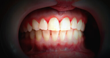 Despite good oral hygiene, localised gingivitis can affect distant healthy areas in mouth