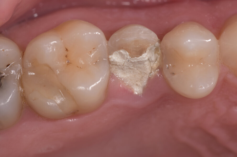 Fig. 1 - Immagine occlusale della frattura coronale dell’elemento in parte medicata per lenire il sintomo termico causato dalla scopertura della camera pulpare.