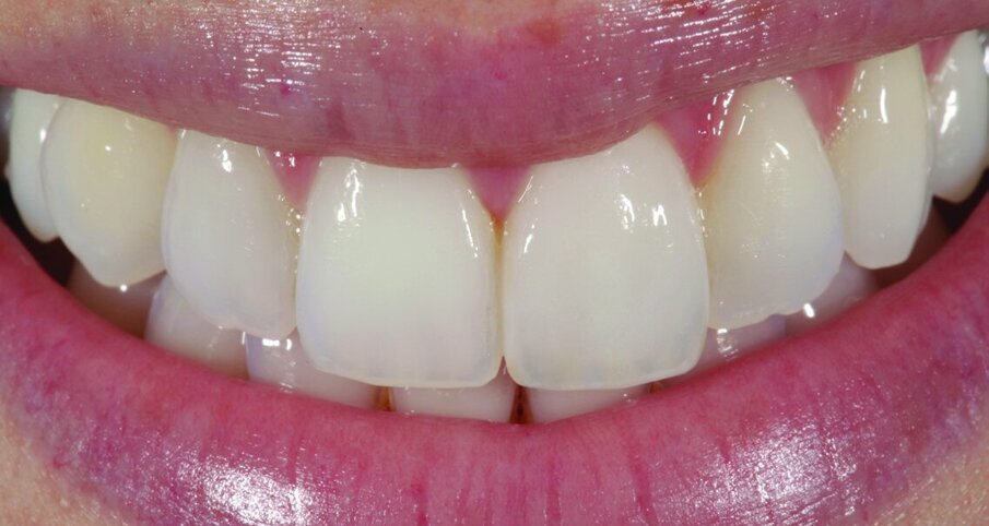 Fig. 8, 9 and 10: The completed crown on the model.