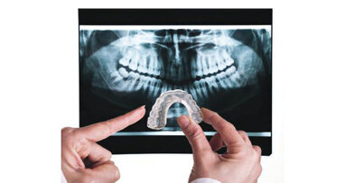 Ακούσιες μεταβολές στη σύγκλειση μετά τη χρήση ναρθήκων βρυγμού