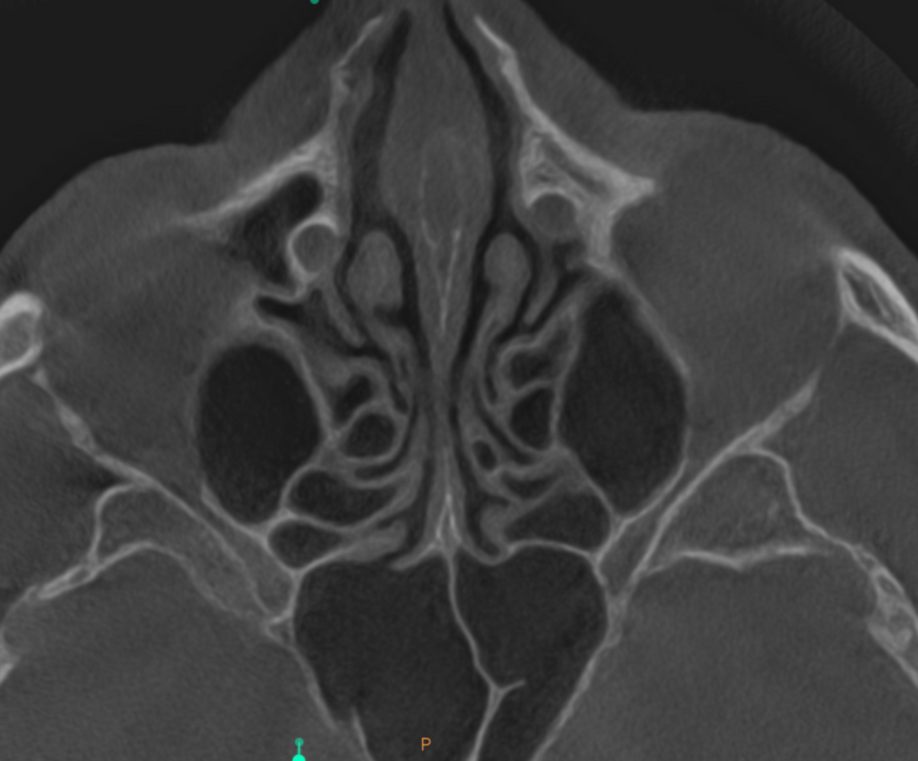 Fig. 9e: High-level transversal cross-section section of the maxilla showing the sphenoid and ethmoid sinuses cleared up.