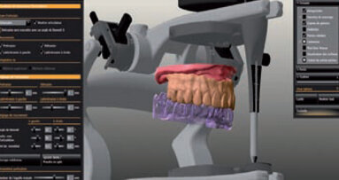 Réhabilitation totale Zircone Prettau® sur piliers implantaires télescopes avec le système CAD/CAM 5-TEC Zirkonzahn