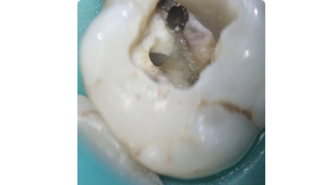 Fig. 31: Cleaned and shaped root canal system.