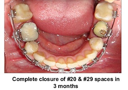 Clinical Trial Results: PROPEL can reduce orthodontic treatment 60 percent or more