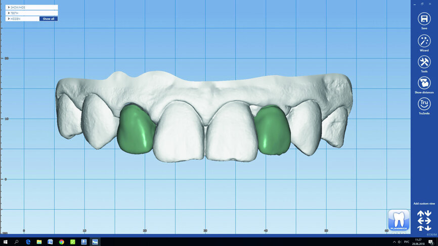 Fig. 15: The final restorations were designed in Planmeca PlanCAD Premium.