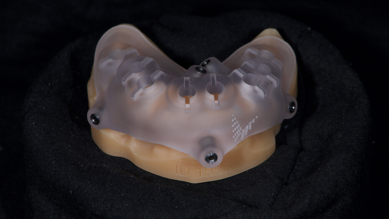 Fig. 7: Surgical guide without metallic sleeves for fully guided implant placement.