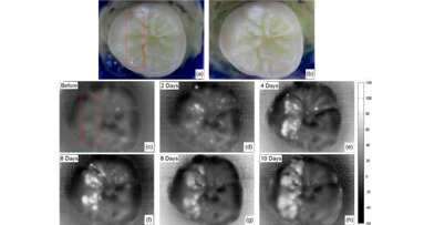 Un nuovo dispositivo di imaging potrebbe facilitare l’individuazione delle carie