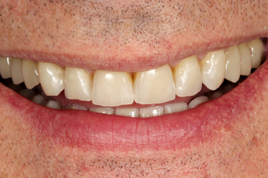 Fig. 22: New teeth with abrasion facets and cracks that suit bruxism patients. Stability, function and inconspicuous integration of the restorations were
the objectives of our work.