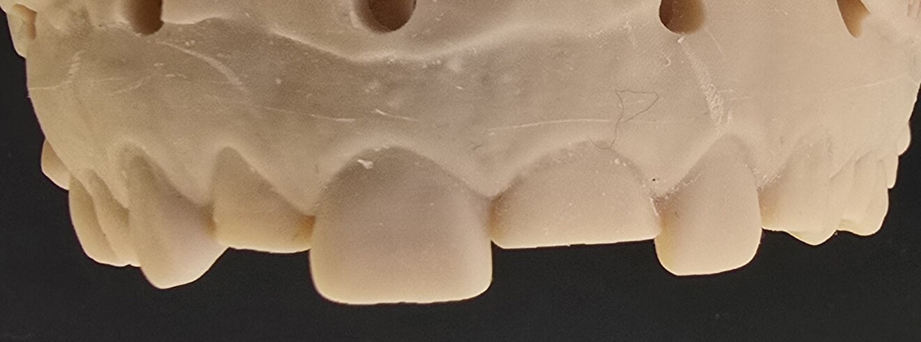Fig. 2a: Diagnostic wax-up showing the planned increase in incisal length.