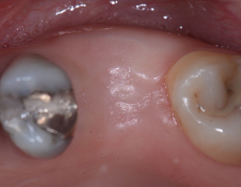 Fig. 8 - Guarigione a 4 mesi