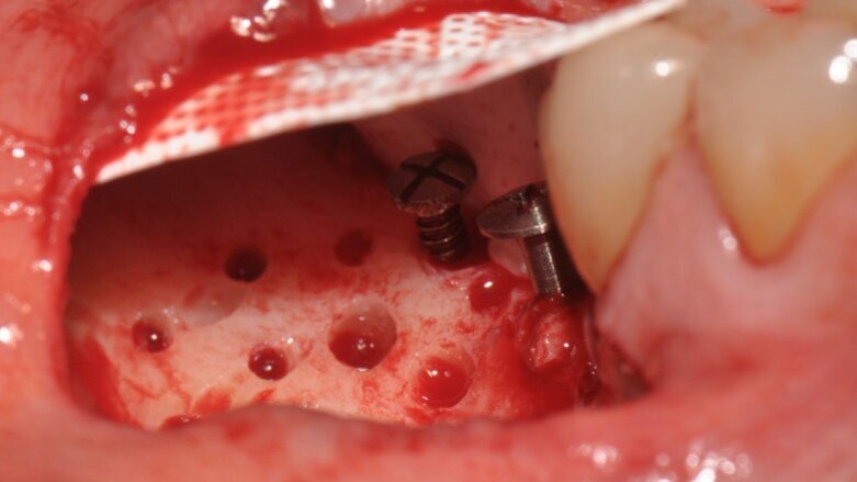 GBR Pocket Technique