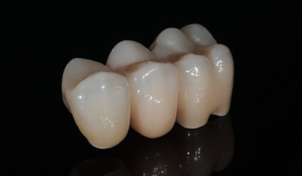 Fig. 10: Finished glazed and characterised restoration. 