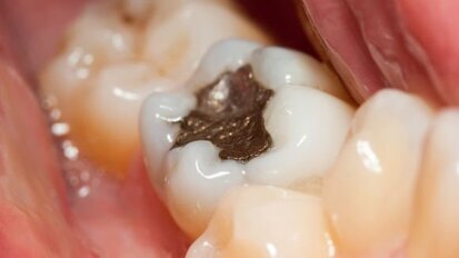 יתכן קשר בין אמלגם להפרעות פיסיולוגיות