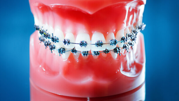 Orthodontisten worden goedkoper