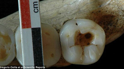 Durant le Paléolithique, les caries se soignaient à coup de silex