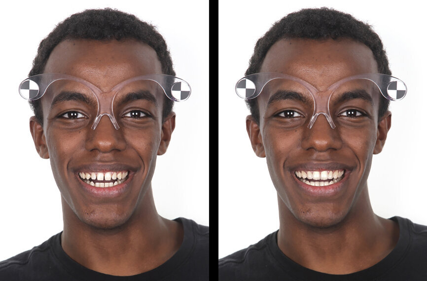 Fig. 14: Intra-oral and extra-oral final digital result.