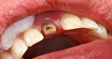 Implant site preservation using a novel post and crown
