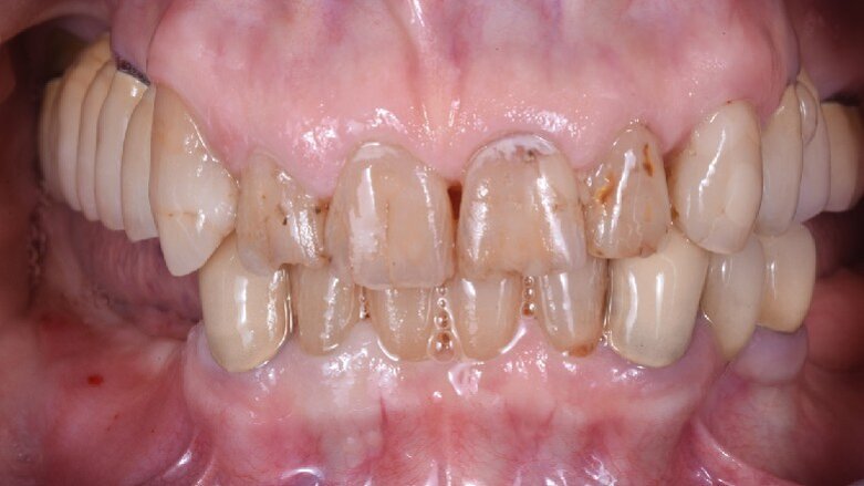 Risoluzione di una grave atrofia ossea con la tecnica della lamina corticale e materiali innovativi