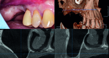 Rialzo di seno per via crestale con una pasta ossea di nuova generazione