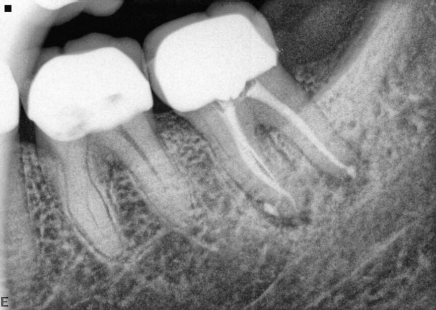 Fig. 17f: Case assisted with CBCT to determine anatomy pre-operatively. Note the multiple cross sections moving apically and the correlation to the 2-D view. Note also the conservative taper in relation to the root width. (Courtesy of Dr. Brett Gilbert)