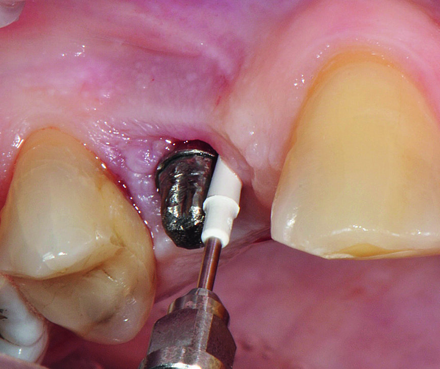 Fig. 5c : Élimination professionnelle du biofilm péri-implantaire par instrument en PEEK (PI, EMS)