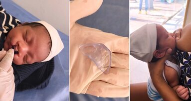 Rehabilitación de bebés con labio y paladar fisurado