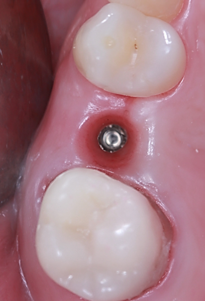 Figs. 17a & b: Occlusal view of sites #15 (a) and 25 after abutment removal (b).