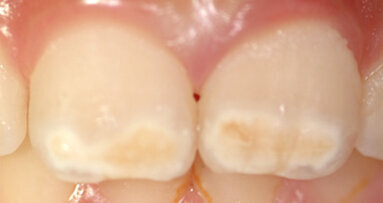 Molárová a incizální hypomineralizace skloviny