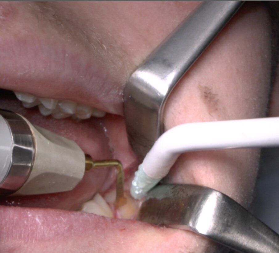 Fig. 5_Ostectomia con terminale piezoelettrico.