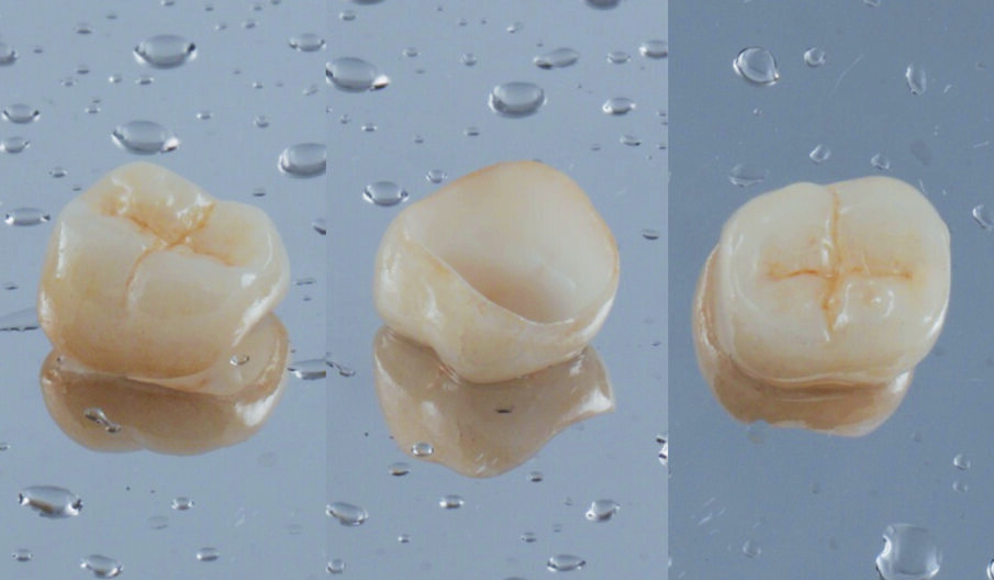 Fig. 4: Fabrication of Lithium disilicate crown  (IPS e.max® CAD).