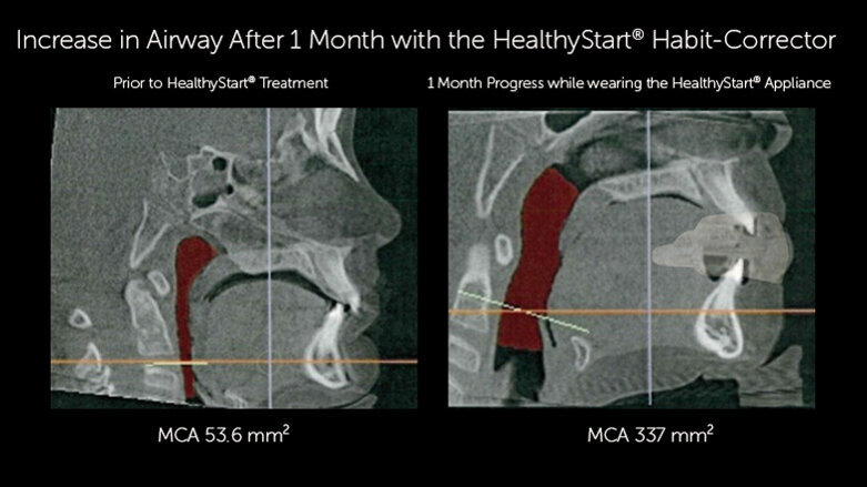 HealthyStart, a comprehensive pediatric airway system, offers online training