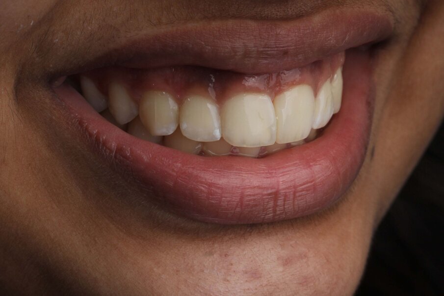 Fig 14. Beautifully integrated restorations