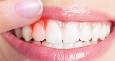 Parodontitis: Zahnärzte fordern bessere Nachsorge