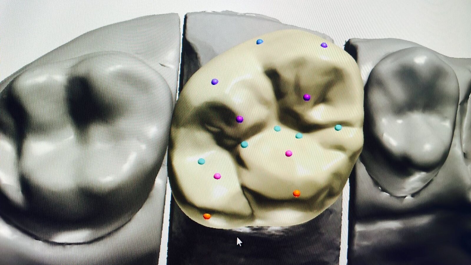 Modelacija krunice - manuelno ili digitalno?