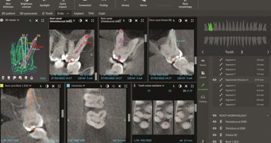 L’utilisation d’un logiciel d’imagerie numérique pour un traitement endocanalaire efficace