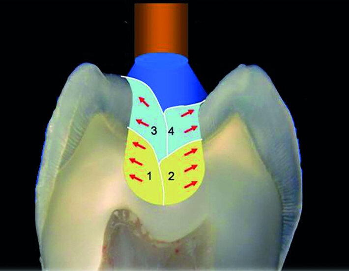 Figs. 8 et 9 : La stratification horizontale n’est pas idéale car les tensions liées a la contraction de polymérisation de la résine composite vont s’exercer sur les parois opposées. La qualité du joint dent/restauration
est meilleure en utilisant une technique de remplissage oblique.