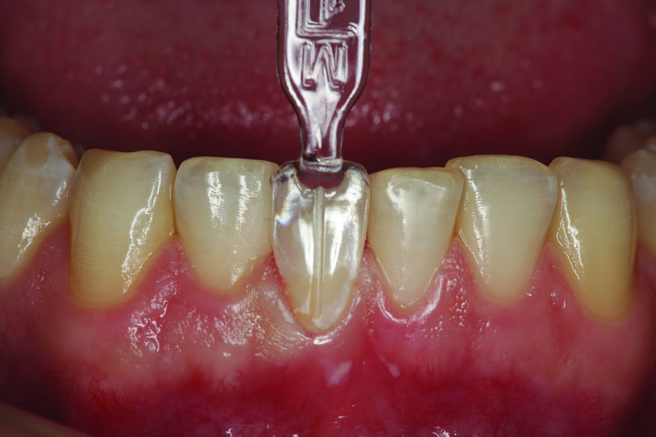 Fig. 7: Uveneer template placed on the facial surface of tooth #41 in proper alignment with the adjacent teeth.