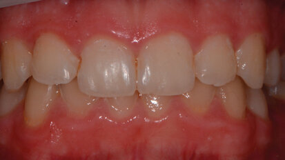 Opportuni scenari di prevenzione in odontoiatria pediatrica: case report