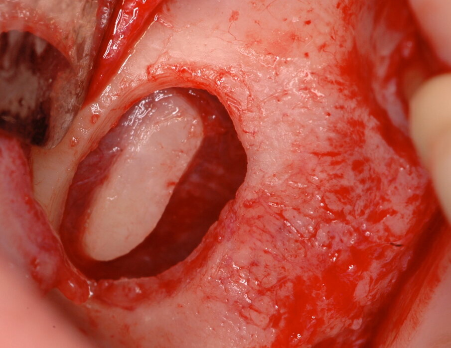Fig. 8_Particolare dell’antrostomia per riflessione, in cui è possibile notare l’integrità della membrana.