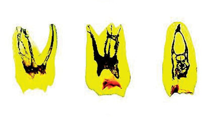 Il punto sull’irrigazione in endodonzia (prima parte)